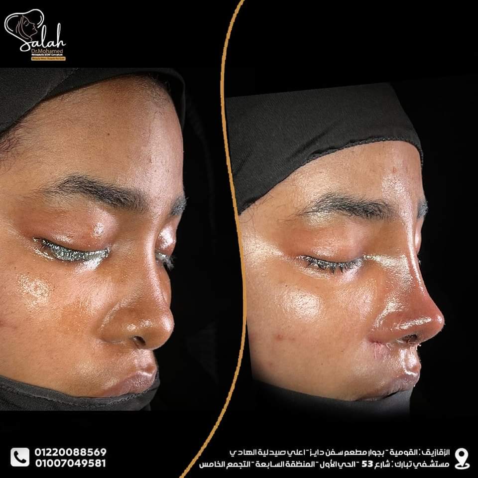 African Nose Rhinoplasty